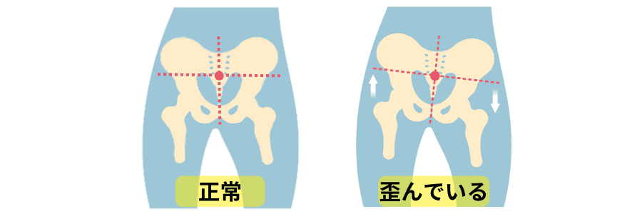 骨盤のゆがみ